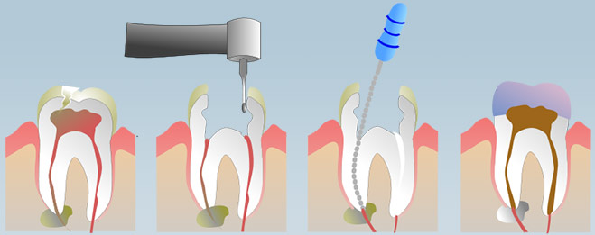 Endodontics