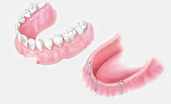 dental implant treatment