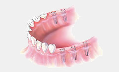 dental implant treatment 7