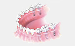 dental implant treatment 8