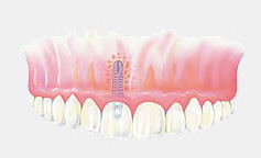dental implant treatment 4