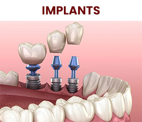 dental implant treatment in turkey