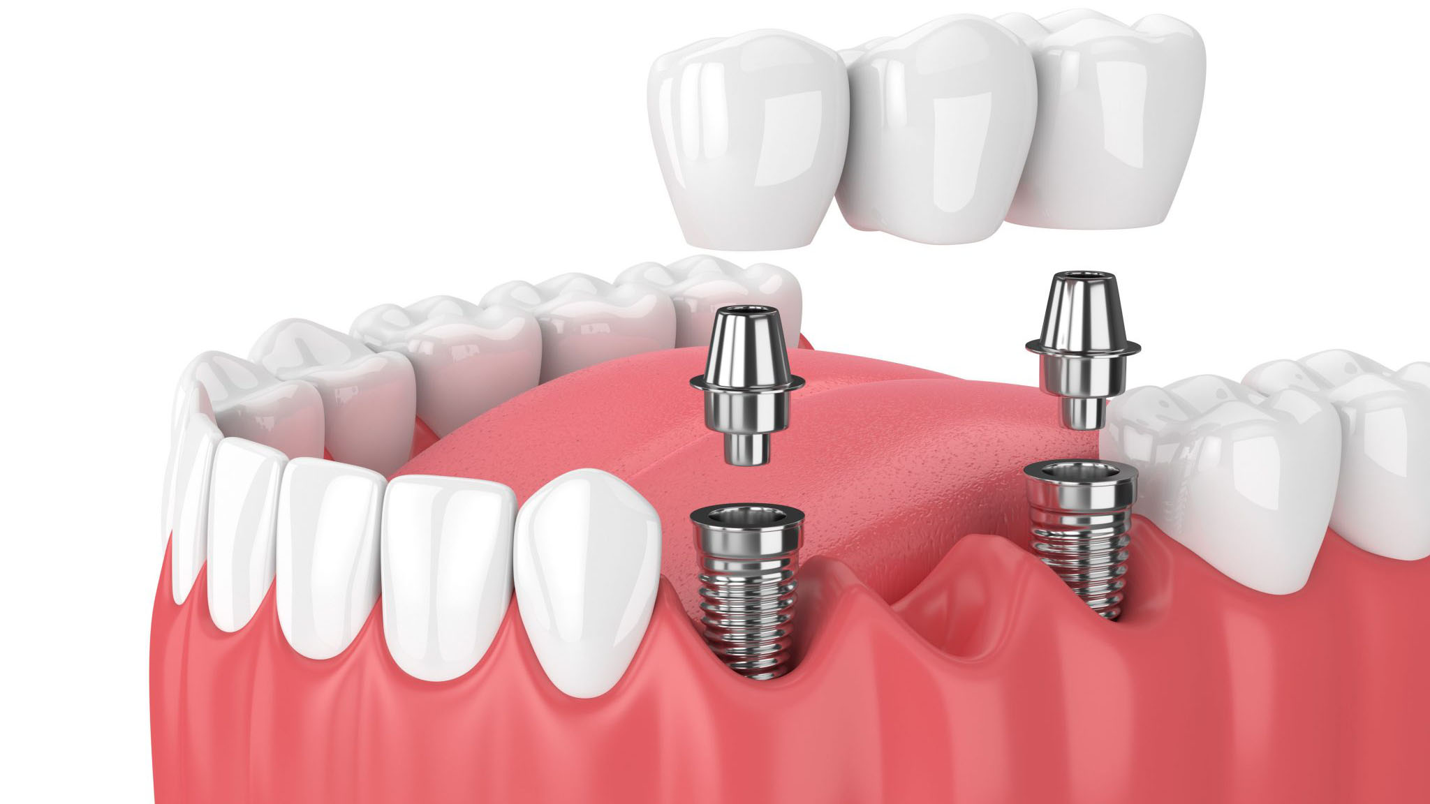 Dental implants