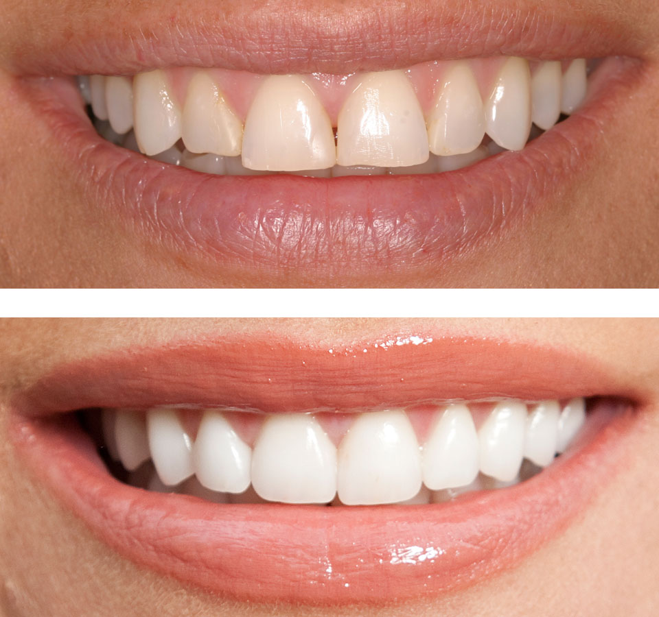 uzmanlar_dental_bonding