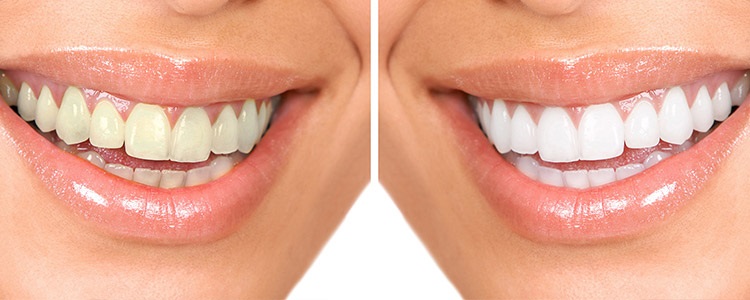 Teeth Whitening (Bleaching) in Turkey