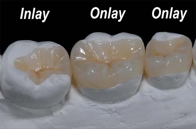 uzmanlar_dental_cosmetic_dentistry_onlay_inlay.jpg