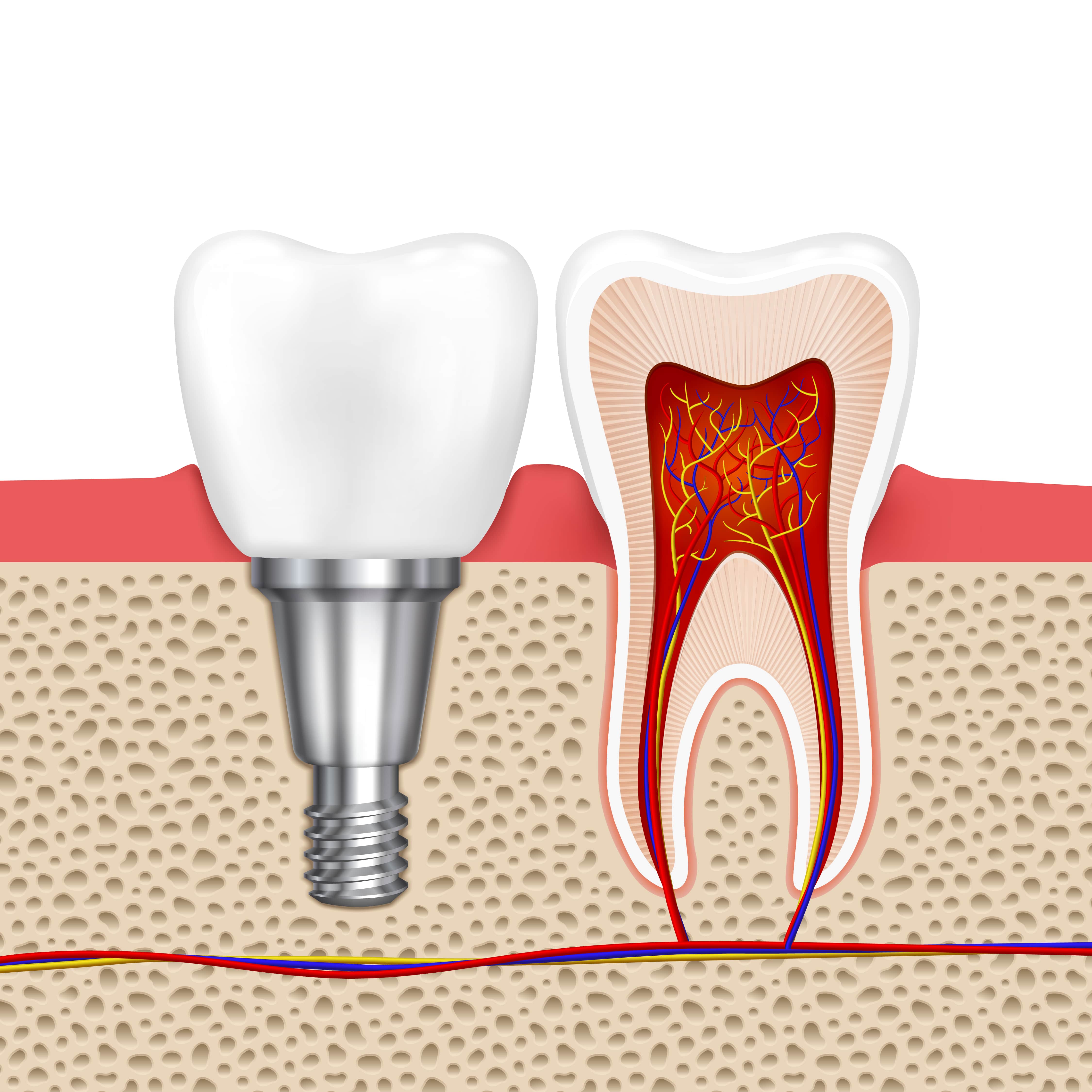 Dental implants