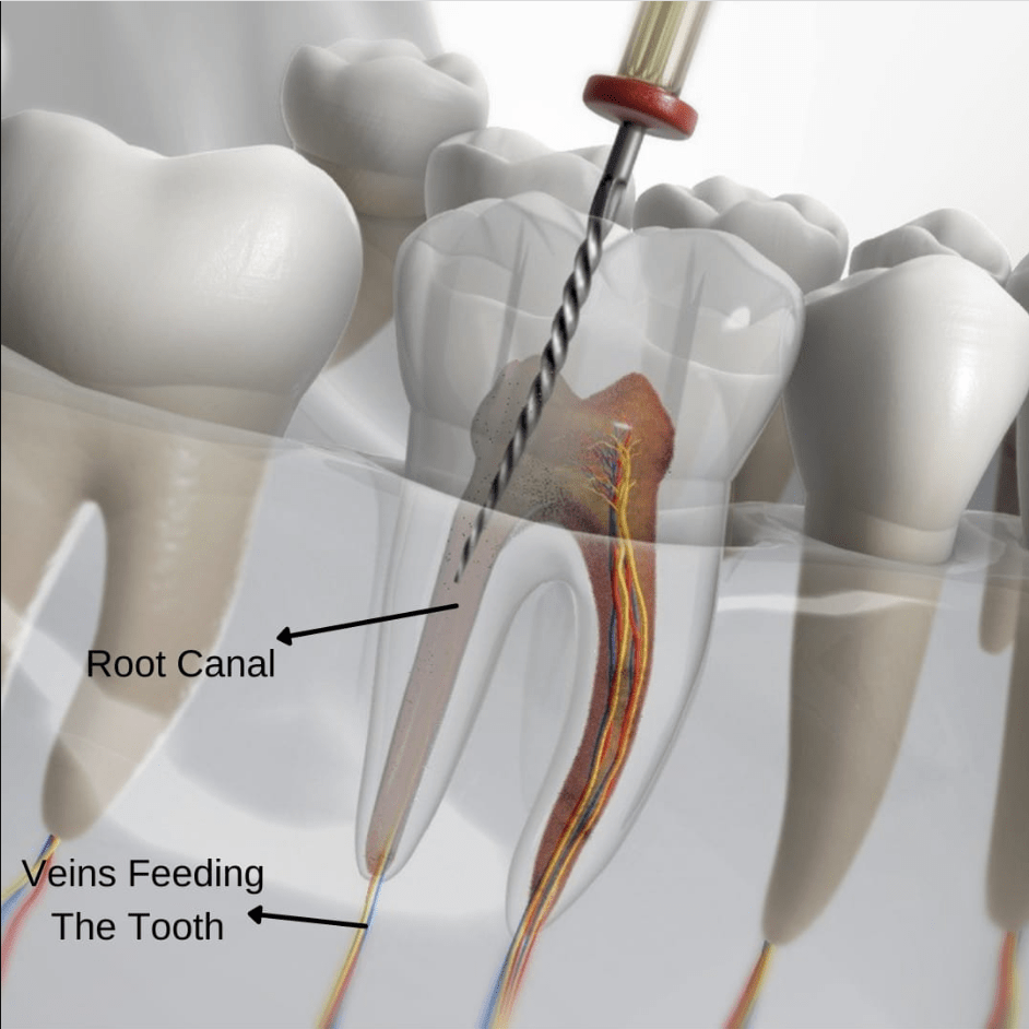 uzmanlar_dental_clinic_root_canal_treatment
