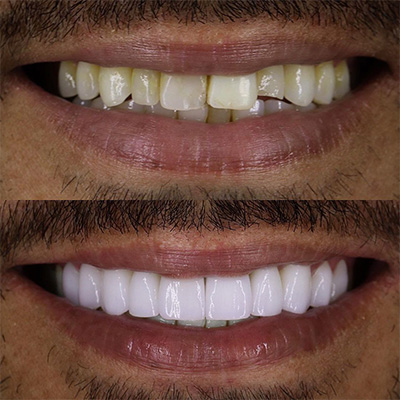 composite-dental-veneers