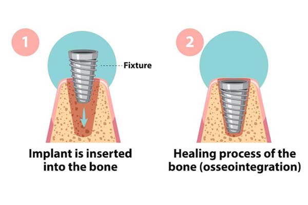preparation-of-dental-implants