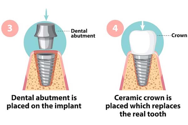 dental-implant-treatment-in-turkey