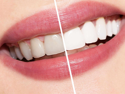teeth-whitening-cleaning-treatment