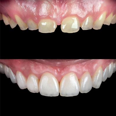 zirconium-dental-veneers